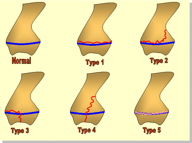 growth_plate